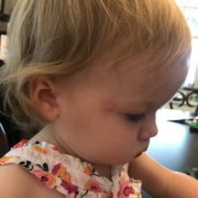lxU8ZDbkRQahIQv3A4BQsw Child with mosquito bite on arm — Spring Valley Pediatrics Washington DC